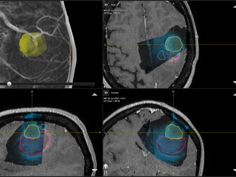 Ultrasound beeldgeleiding bij wakkere hersenchirurgie - 2