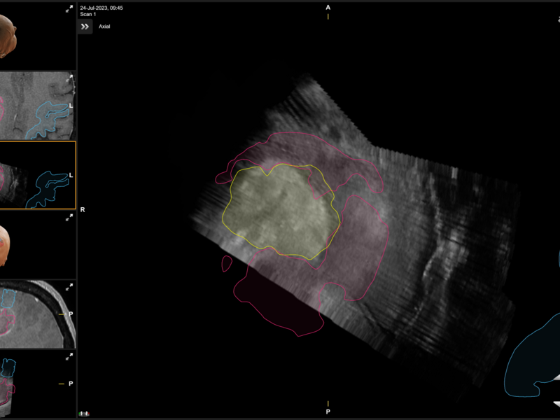 Ultrasound beeldgeleiding bij wakkere hersenchirurgie - 4