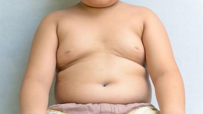 obesitas bij kinderen