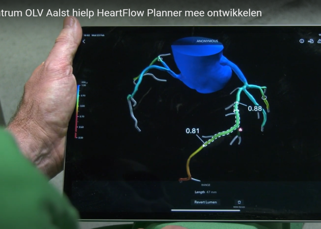 De HeartFlow-Planner - virtual stenting